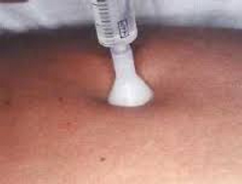 Multiniettori monouso con aghi - Mesorelle